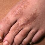 – Medical malpractice, close-up, foot scarring, adult female, Bronx, NY.
