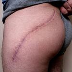 – Medical Malpractice, personal injury, motorcycle accident, left hip scarring, adult male, Brooklyn, NY.